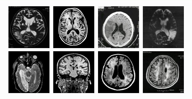 그림 - 혈관성 치매 MRI 사진